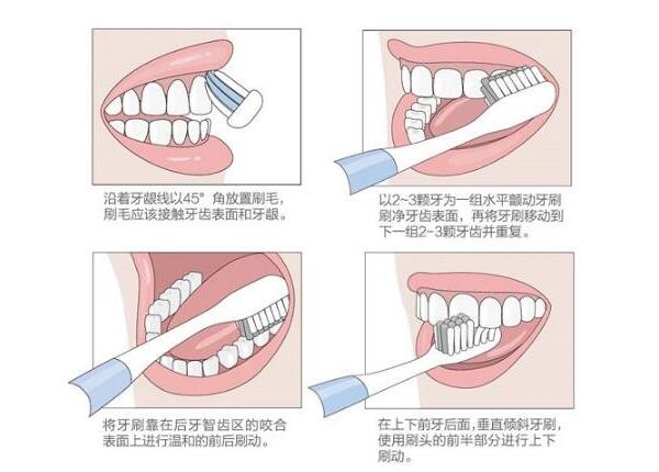 圆头声波电动牙刷刷牙方法之巴氏刷牙法